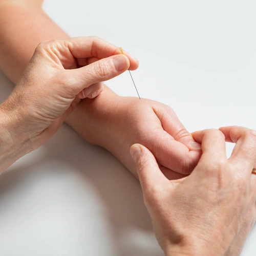 Akupunktur